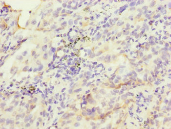HK3 / Hexokinase 3 Antibody - Immunohistochemistry of paraffin-embedded human lung cancer at dilution of 1:100