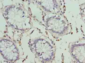 HKDC1 Antibody - Immunohistochemistry of paraffin-embedded human colon cancer using antibody at dilution of 1:100.