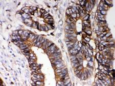 HLA-A Antibody - HLA-A antibody IHC-paraffin: Human Intestinal Cancer Tissue.