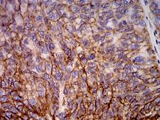 HLA-B Antibody - Immunohistochemical analysis of paraffin-embedded ovarian cancer tissues using HLA-B mouse mAb with DAB staining.