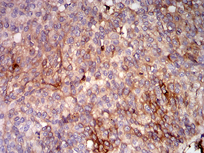 HLA-B Antibody - Immunohistochemical analysis of paraffin-embedded bladder cancer tissues using HLA-B mouse mAb with DAB staining.