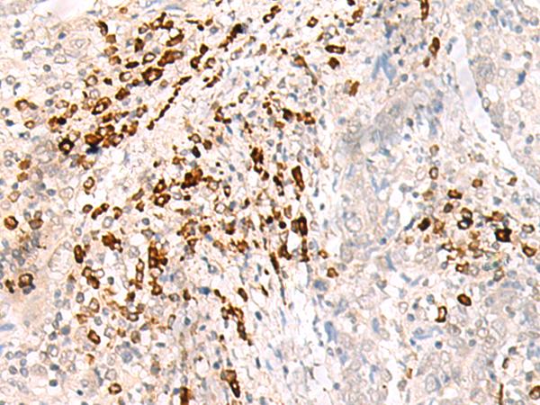 HLA-B Antibody - Immunohistochemistry of paraffin-embedded Human cervical cancer tissue  using HLA-B Polyclonal Antibody at dilution of 1:30(×200)