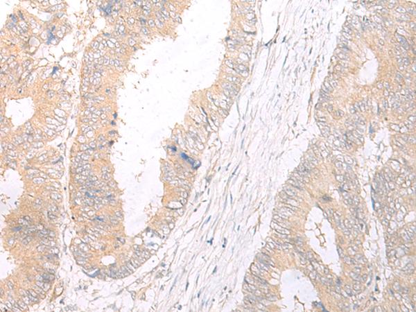 HLA-C Antibody - Immunohistochemistry of paraffin-embedded Human colorectal cancer tissue  using HLA-C Polyclonal Antibody at dilution of 1:25(×200)