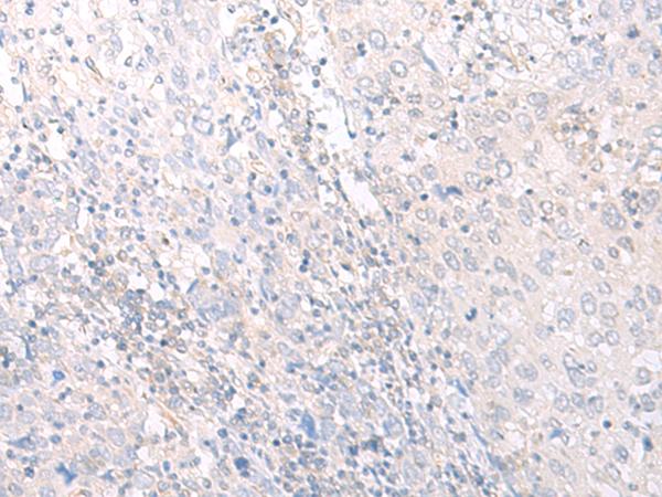 HLA-C Antibody - Immunohistochemistry of paraffin-embedded Human cervical cancer tissue  using HLA-C Polyclonal Antibody at dilution of 1:25(×200)