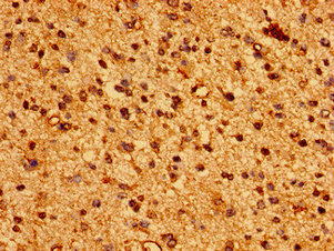 HLA Class I Histocompatibility Antigen, C-4 Alpha Chain Antibody - Immunohistochemistry image of paraffin-embedded human glioma cancer at a dilution of 1:100