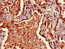 HLA Class II Histocompatibility Antigen, DRB1-3 Antibody - Immunohistochemistry of paraffin-embedded human lung cancer using HLA-DRB1 Antibody, Biotin conjugated at dilution of 1:100