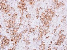 HLA-DMA Antibody - IHC of paraffin-embedded Breast ca using HLA-DMA antibody at 1:250 dilution.