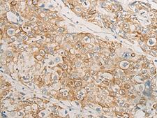 HLA-DMB Antibody - Immunohistochemistry of paraffin-embedded Human prost at e cancer tissue  using HLA-DMB Polyclonal Antibody at dilution of 1:40(×200)