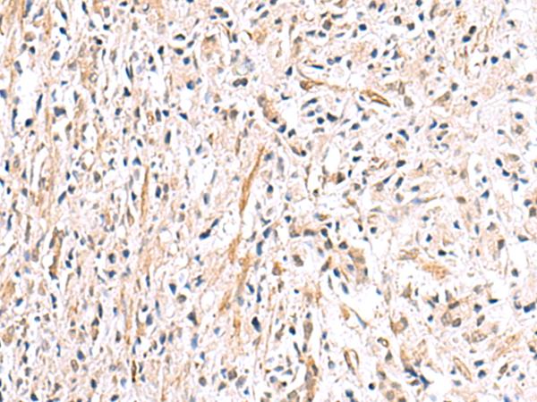 HLA-DOB Antibody - Immunohistochemistry of paraffin-embedded Human prost ate cancer tissue  using HLA-DOB Polyclonal Antibody at dilution of 1:40(×200)