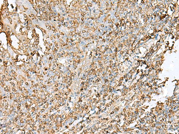 HLA-DPB1 Antibody - Immunohistochemistry of paraffin-embedded Human tonsil tissue  using HLA-DPB1 Polyclonal Antibody at dilution of 1:45(×200)