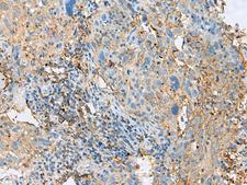 HLA-DPB1 Antibody - Immunohistochemistry of paraffin-embedded Human cervical cancer tissue  using HLA-DPB1 Polyclonal Antibody at dilution of 1:50(×200)