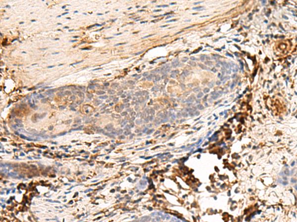 HLA-DQB1 Antibody - Immunohistochemistry of paraffin-embedded Human esophagus cancer tissue  using HLA-DQB1 Polyclonal Antibody at dilution of 1:30(×200)