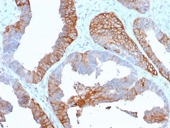 HLA-DRA Antibody - IHC staining of FFPE human prostate cancer with HLA-DR antibody (clone TAL 1B5). HIER: boil tissue sections in pH6, 10mM citrate buffer, for 10-20 min and allow to cool before testing.