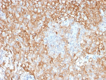 HLA-DRA Antibody - IHC staining of FFPE human lung cancer with HLA-DR antibody (clone TAL 1B5). HIER: boil tissue sections in pH6, 10mM citrate buffer, for 10-20 min and allow to cool before testing.