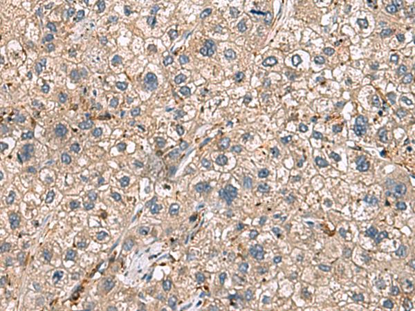 HLA-DRA Antibody - Immunohistochemistry of paraffin-embedded Human liver cancer tissue  using HLA-DRA Polyclonal Antibody at dilution of 1:30(×200)