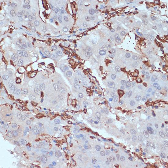 HLA-DRA Antibody - Immunohistochemistry of paraffin-embedded Human liver cancer using HLA-DRA Polyclonal Antibody at dilution of 1:100 (40x lens).