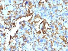 HLA-DRB1 Antibody - Formalin-fixed, paraffin-embedded human Histiocytoma stained with HLA-DRB antibody (HLA-DRB/1067).  This image was taken for the unmodified form of this product. Other forms have not been tested.