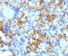 HLA-DRB1 Antibody - IHC analysis of human histiocytoma and HLA-DRB1 antibody (clone LN3).  This image was taken for the unmodified form of this product. Other forms have not been tested.