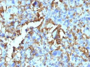 HLA-DRB1 Antibody - IHC: Formalin-fixed, paraffin-embedded human histiocytoma stained with HLA-DRB1 antibody (LN3 + HLA-DRB/1067).  This image was taken for the unmodified form of this product. Other forms have not been tested.