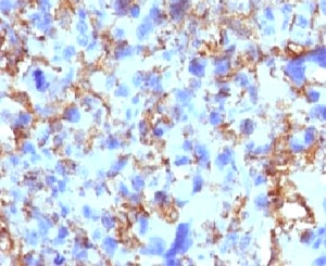 HLA-DRB1 Antibody - IHC testing of FFPE human histiocytoma and HLA-DRB1 antibody (clone MHDRb2).  This image was taken for the unmodified form of this product. Other forms have not been tested.