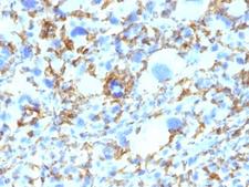 HLA-DRB1 Antibody - Formalin-fixed, paraffin-embedded human Histiocytoma stained with anti-HLA-DRB1 antibody (SPM423).  This image was taken for the unmodified form of this product. Other forms have not been tested.