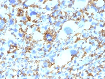 HLA-DRB1 Antibody - Formalin-fixed, paraffin-embedded human Histiocytoma stained with anti-HLA-DRB1 antibody (SPM423).  This image was taken for the unmodified form of this product. Other forms have not been tested.
