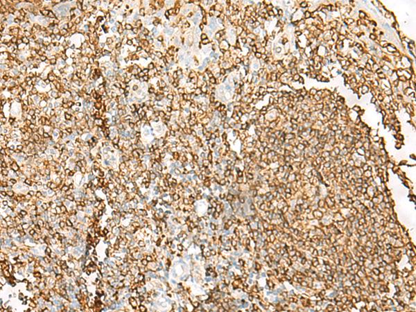 HLA-DRB1 Antibody - Immunohistochemistry of paraffin-embedded Human tonsil tissue  using HLA-DRB1 Polyclonal Antibody at dilution of 1:65(×200)