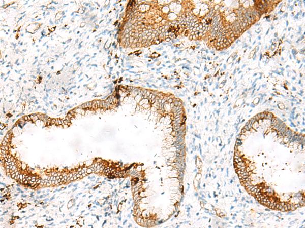 HLA-DRB1 Antibody - Immunohistochemistry of paraffin-embedded Human cervical cancer tissue  using HLA-DRB1 Polyclonal Antibody at dilution of 1:65(×200)