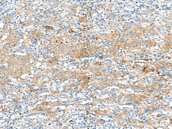 HLA-DRB3 Antibody - Immunohistochemistry of paraffin-embedded Human cervical cancer tissue  using HLA-DRB3 Polyclonal Antibody at dilution of 1:50(×200)