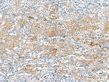 HLA-DRB3 Antibody - Immunohistochemistry of paraffin-embedded Human cervical cancer tissue  using HLA-DRB3 Polyclonal Antibody at dilution of 1:50(×200)