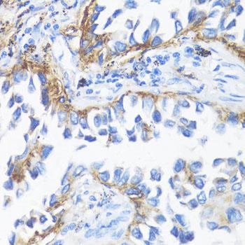 HLA-DRB3 Antibody - Immunohistochemistry of paraffin-embedded Human lung cancer using HLA-DRB3 Polyclonal Antibody at dilution of 1:100 (40x lens).