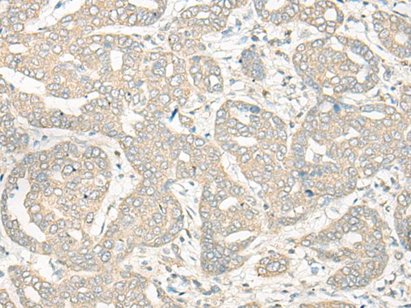 HLA-DRB5 Antibody - Immunohistochemistry of paraffin-embedded Human liver cancer tissue  using HLA-DRB5 Polyclonal Antibody at dilution of 1:45(×200)
