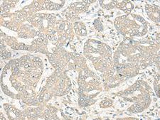 HLA-DRB5 Antibody - Immunohistochemistry of paraffin-embedded Human liver cancer tissue  using HLA-DRB5 Polyclonal Antibody at dilution of 1:45(×200)