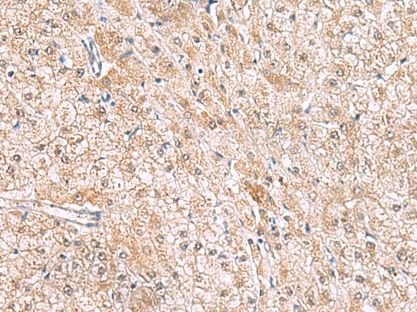 HLA-E Antibody - Immunohistochemistry of paraffin-embedded Human liver cancer tissue  using HLA-E Polyclonal Antibody at dilution of 1:50(×200)