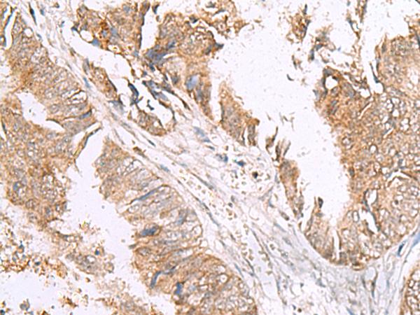 HLA-E Antibody - Immunohistochemistry of paraffin-embedded Human colorectal cancer tissue  using HLA-E Polyclonal Antibody at dilution of 1:50(×200)
