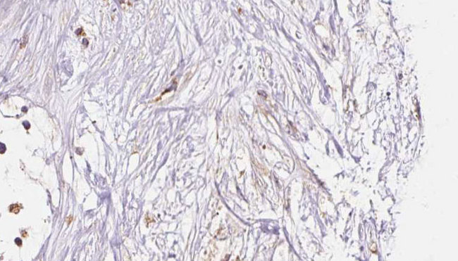 HLA-F Antibody - 1:100 staining human liver carcinoma tissues by IHC-P. The sample was formaldehyde fixed and a heat mediated antigen retrieval step in citrate buffer was performed. The sample was then blocked and incubated with the antibody for 1.5 hours at 22°C. An HRP conjugated goat anti-rabbit antibody was used as the secondary.