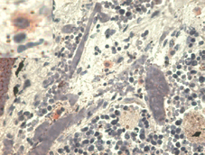 HLA-G Antibody - Immunohistochemistry staining with anti-human HLA-G (MEM-G/1) - pulmonary disseases (paraffin-embedded sections). The antibody MEM-G/1 stains infiltrating macrophages in pulmonary diseases. In the top left corner see the detail of macrophage.