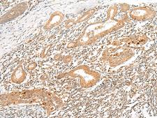 HLA-G Antibody - Immunohistochemistry of paraffin-embedded Human esophagus cancer tissue  using HLA-G Polyclonal Antibody at dilution of 1:45(×200)