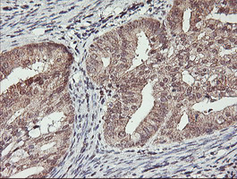 HLCS / HCS Antibody - IHC of paraffin-embedded Adenocarcinoma of Human endometrium tissue using anti-HLCS mouse monoclonal antibody.