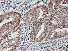 HLCS / HCS Antibody - IHC of paraffin-embedded Adenocarcinoma of Human endometrium tissue using anti-HLCS mouse monoclonal antibody.