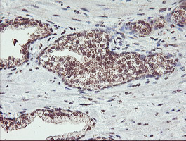 HLCS / HCS Antibody - IHC of paraffin-embedded Carcinoma of Human prostate tissue using anti-HLCS mouse monoclonal antibody.