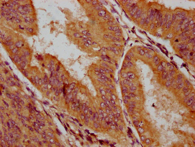 HLCS / HCS Antibody - Immunohistochemistry Dilution at 1:200 and staining in paraffin-embedded human endometrial cancer performed on a Leica BondTM system. After dewaxing and hydration, antigen retrieval was mediated by high pressure in a citrate buffer (pH 6.0). Section was blocked with 10% normal Goat serum 30min at RT. Then primary antibody (1% BSA) was incubated at 4°C overnight. The primary is detected by a biotinylated Secondary antibody and visualized using an HRP conjugated SP system.