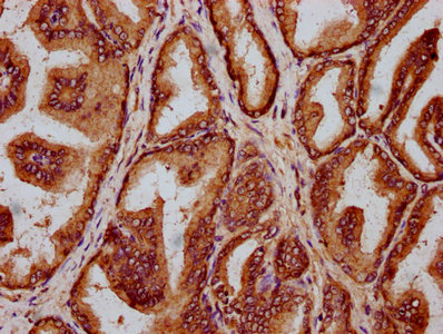 HLCS / HCS Antibody - Immunohistochemistry Dilution at 1:200 and staining in paraffin-embedded human prostate tissue performed on a Leica BondTM system. After dewaxing and hydration, antigen retrieval was mediated by high pressure in a citrate buffer (pH 6.0). Section was blocked with 10% normal Goat serum 30min at RT. Then primary antibody (1% BSA) was incubated at 4°C overnight. The primary is detected by a biotinylated Secondary antibody and visualized using an HRP conjugated SP system.