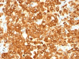 HMB45 Antibody - IHC staining of human melanoma with gp100 antibody (HMB45).