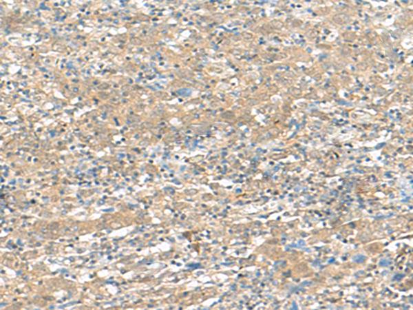 HMBOX1 Antibody - Immunohistochemistry of paraffin-embedded Human cervical cancer tissue  using HMBOX1 Polyclonal Antibody at dilution of 1:30(×200)