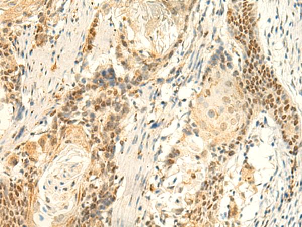 HMBOX1 Antibody - Immunohistochemistry of paraffin-embedded Human esophagus cancer tissue  using HMBOX1 Polyclonal Antibody at dilution of 1:50(×200)