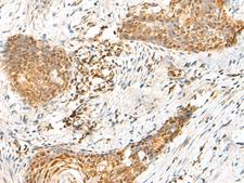 HMBOX1 Antibody - Immunohistochemistry of paraffin-embedded Human esophagus cancer tissue  using HMBOX1 Polyclonal Antibody at dilution of 1:60(×200)
