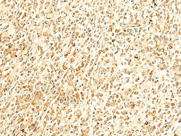 HMBOX1 Antibody - Immunohistochemistry of paraffin-embedded Human gastric cancer tissue  using HMBOX1 Polyclonal Antibody at dilution of 1:50(×200)
