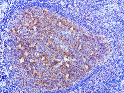HMBS / PBGD Antibody - Immunohistochemical staining of paraffin-embedded human tonsil using anti-HMBS clone UMAB144 mouse monoclonal antibody at 1:400 with Polink2 Broad HRP DAB detection kit ; heat-induced epitope retrieval with citrate buffer, pH6.0at 95-100C. Strong cytoplasmic and membraneous staining is seen on tonsil germinal and non-germinal centers. Some weak nuclear stain was also observed.