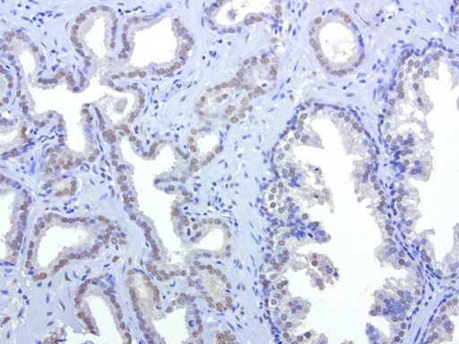 HMBS / PBGD Antibody - Immunohistochemical staining of paraffin-embedded human prostate cancer using anti-HMBS clone UMAB144 mouse monoclonal antibody at 1:400 with Polink2 Broad HRP DAB detection kit ; heat-induced epitope retrieval with citrate buffer, pH6.0at 95-100C. Weak nuclear staining is seen on tumor cells.